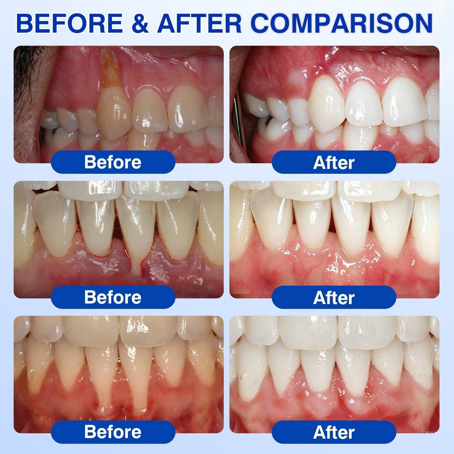 👨‍⚕️🦷🛡️BBOJI®GumRevive Periodontal Repair Gel