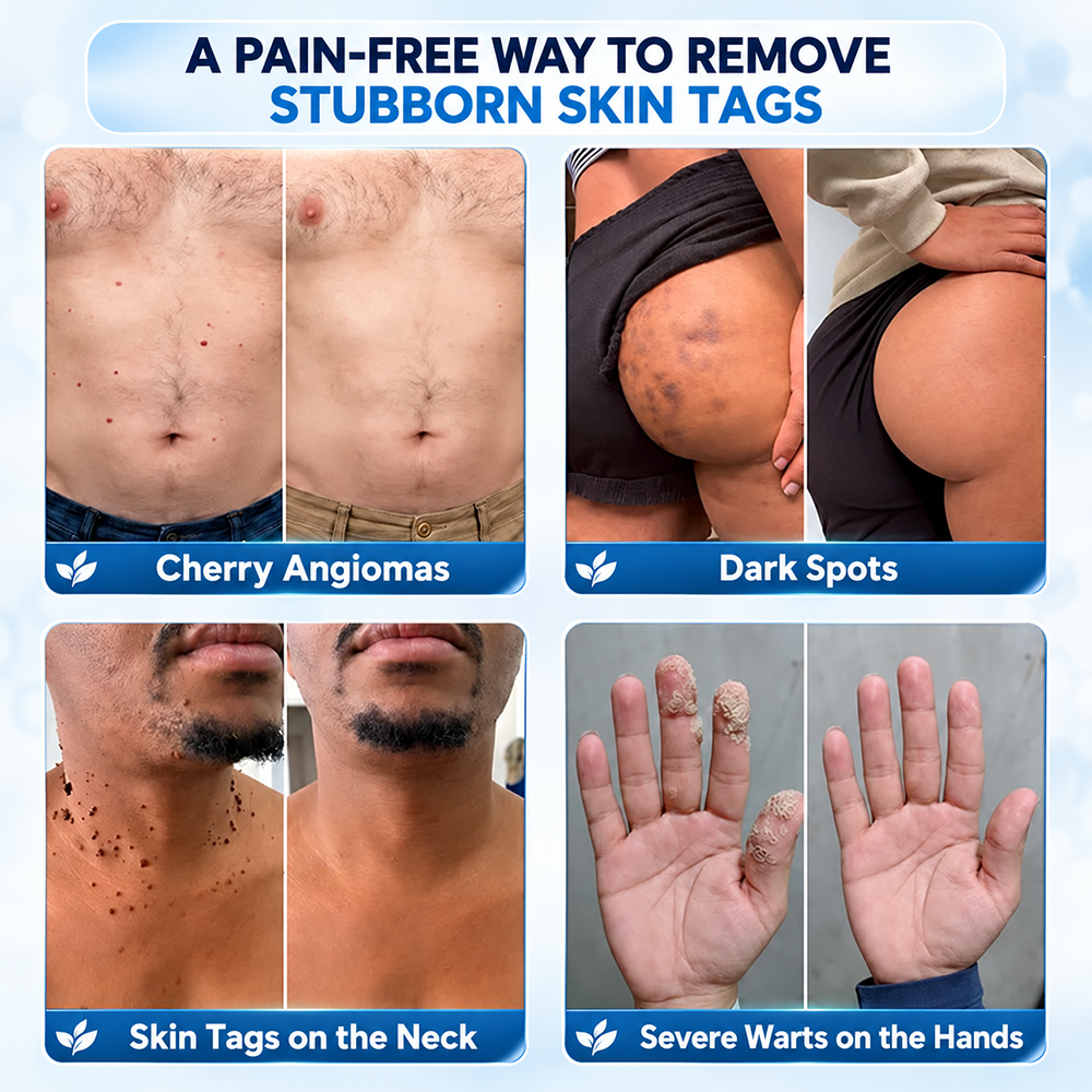 TERVENCE® 🧑‍⚕️ 7-Day Cream for Skin Growths & Pigmentation Spots (painless formula – scar-free)🌿2️⃣