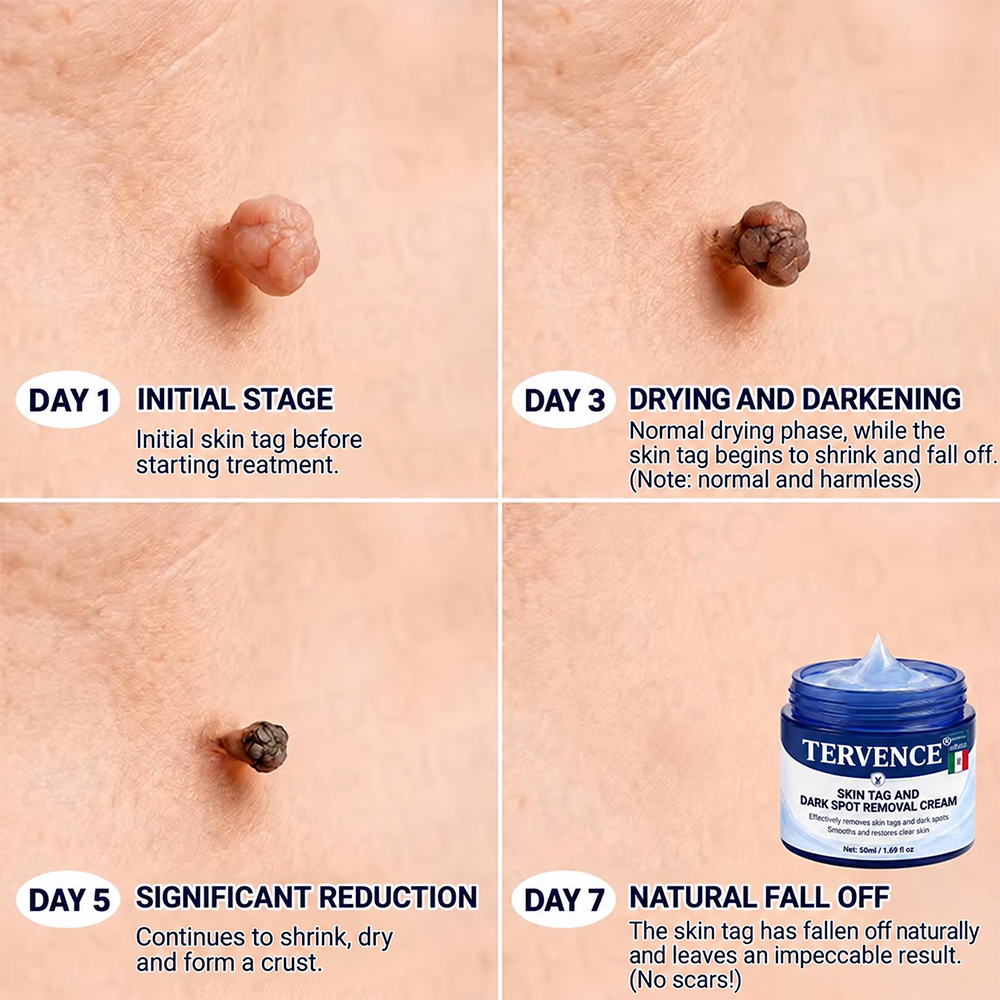 TERVENCE® 🧑‍⚕️ 7-Day Cream for Skin Growths & Pigmentation Spots (painless formula – scar-free)🌿2️⃣