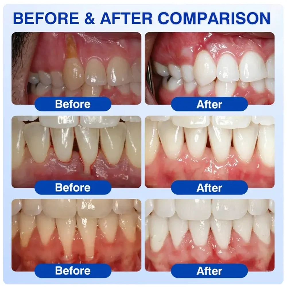 TERVENCE® 🏆GumRevive Periodontal Care Gel