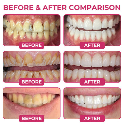 TERVENCE®Cavity-Repair Natural Enamel Filling Gel