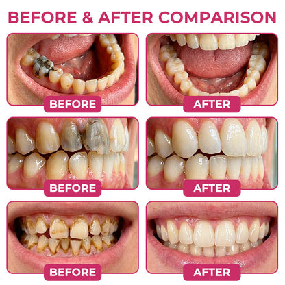 TERVENCE®Cavity-Repair Natural Enamel Filling Gel